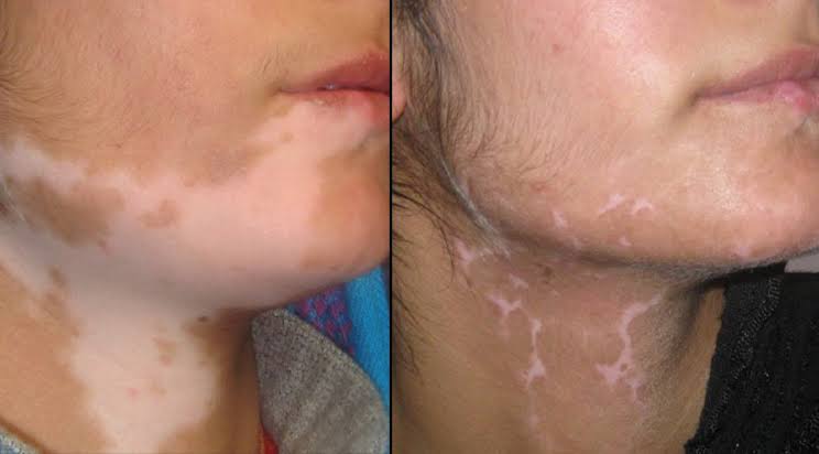 Vitiligo Surgery
